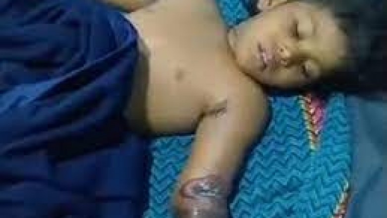 कोरबा की एक चार साल की मासूम बच्ची बिजली के झटके से झुलस गई