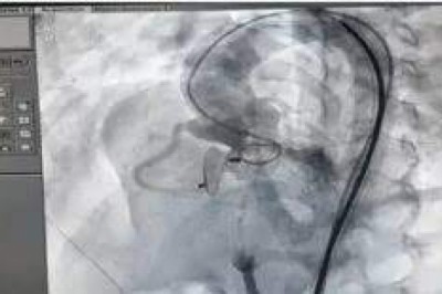 छत्तीसगढ़ में दिल के मर्ज के इलाज में नए प्रयोग हो रहे