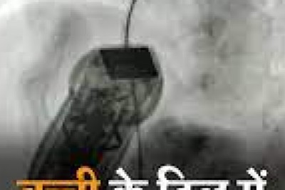 भोपाल में 4 साल की बच्ची के दिल का छेद बंद करते वक्त  छोटी सी डिवाइस अंदर छूट गई,