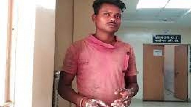 दूसरी' के शक में पत्नी ने खुद को लगाई आग:पति के मोबाइल पर रॉन्ग नंबर से आता था