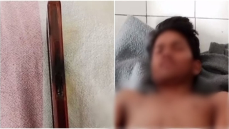 अचानक ब्लास्ट के बाद हुआ ये हाल, सावधान! चार्जिंग के दौरान मोबाइल पर बात करना युवक को पड़ा भारी